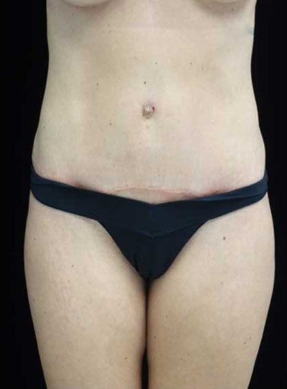 Tummy Tuck Before & After Patient #15145