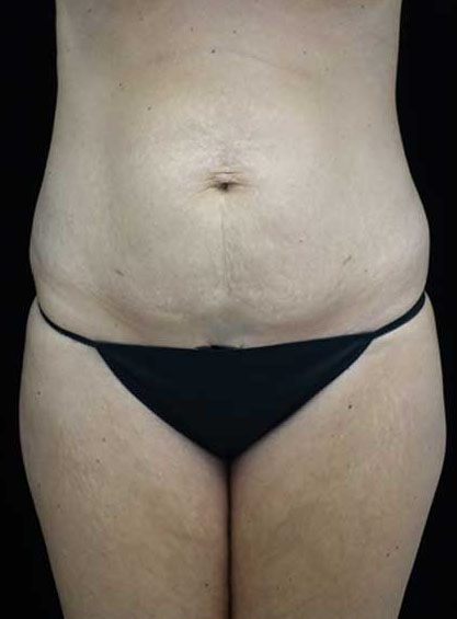 Tummy Tuck Before & After Patient #15145