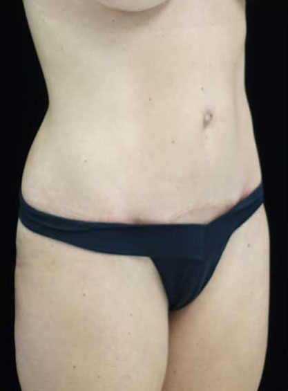 Tummy Tuck Before & After Patient #15145