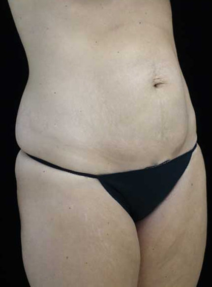 Tummy Tuck Before & After Patient #15145