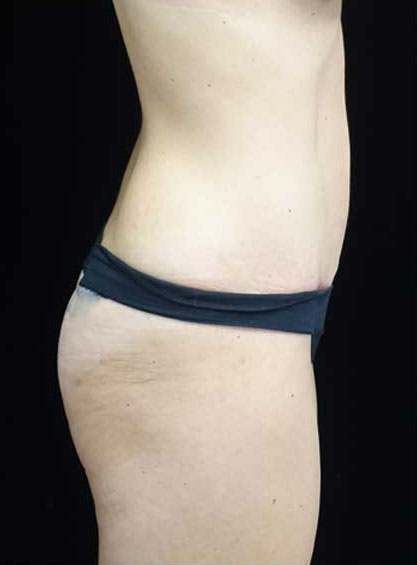 Tummy Tuck Before & After Patient #15145