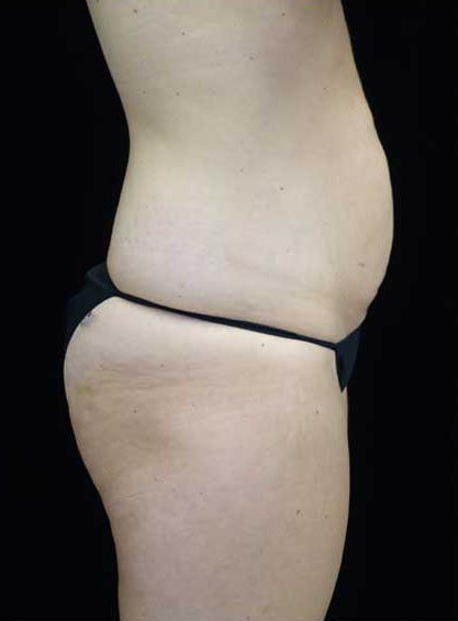 Tummy Tuck Before & After Patient #15145