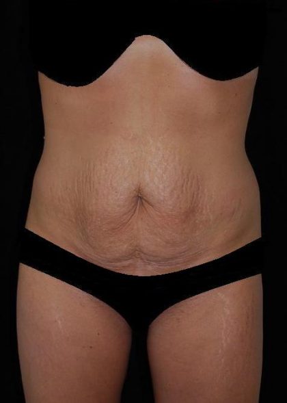 Tummy Tuck Before & After Patient #15181