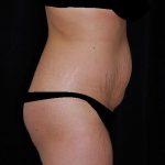 Tummy Tuck Before & After Patient #15181