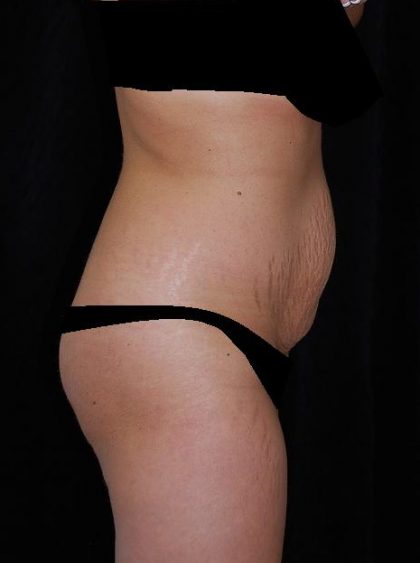 Tummy Tuck Before & After Patient #15181