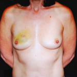 Breast Reconstructions Before & After Patient #15220
