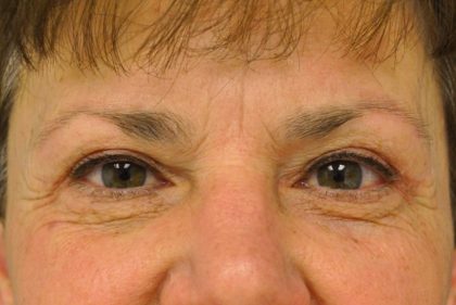 Blepharoplasty Before & After Patient #13889