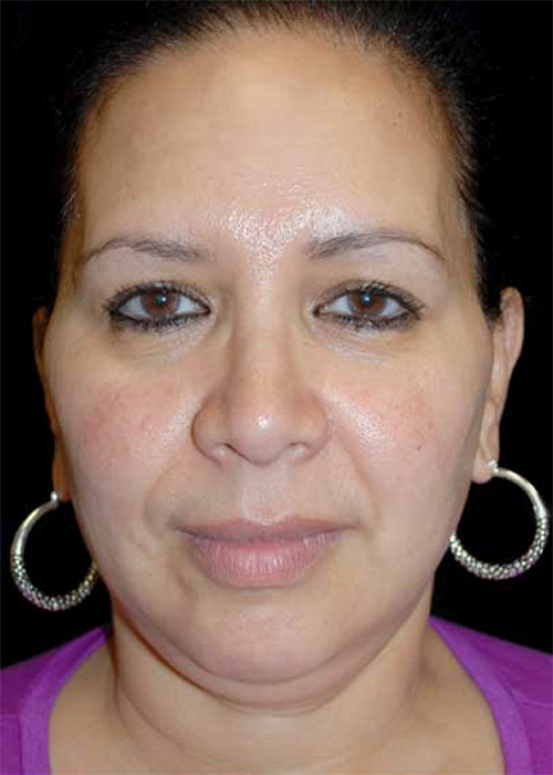 Liposuction Before & After Patient #14806
