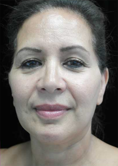 Liposuction Before & After Patient #14806