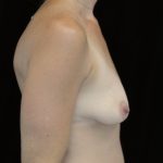 Breast Augmentation (Implants) Before & After Patient #14244