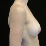 Breast Augmentation (Implants) Before & After Patient #14220