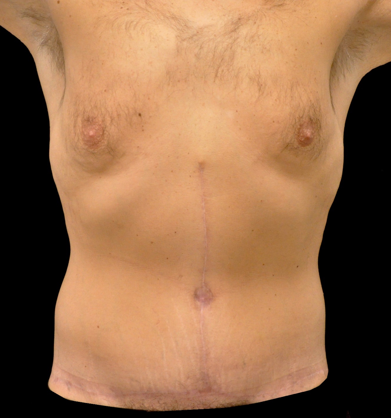 Lower Body Lift Before & After Patient #15316