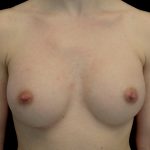 Breast Augmentation (Implants) Before & After Patient #14253