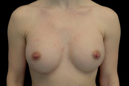 Breast Augmentation (Implants) Before & After Patient #14253