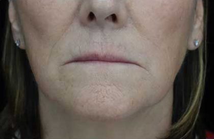 Fat Transfer to Face Before & After Patient #14934