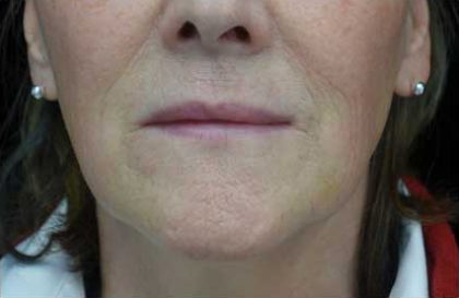 Fat Transfer to Face Before & After Patient #14934