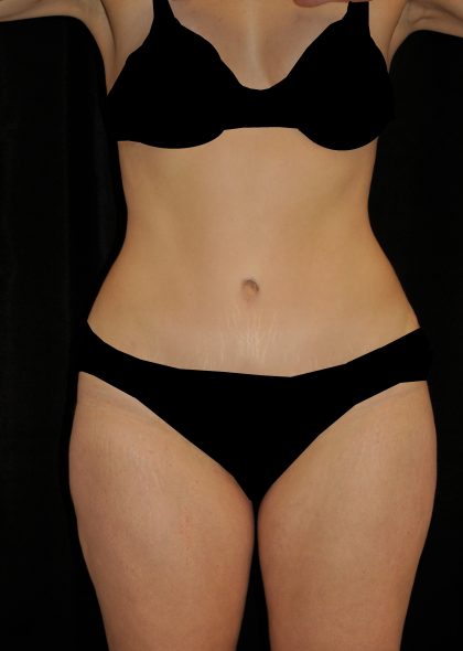 Tummy Tuck Before & After Patient #15093