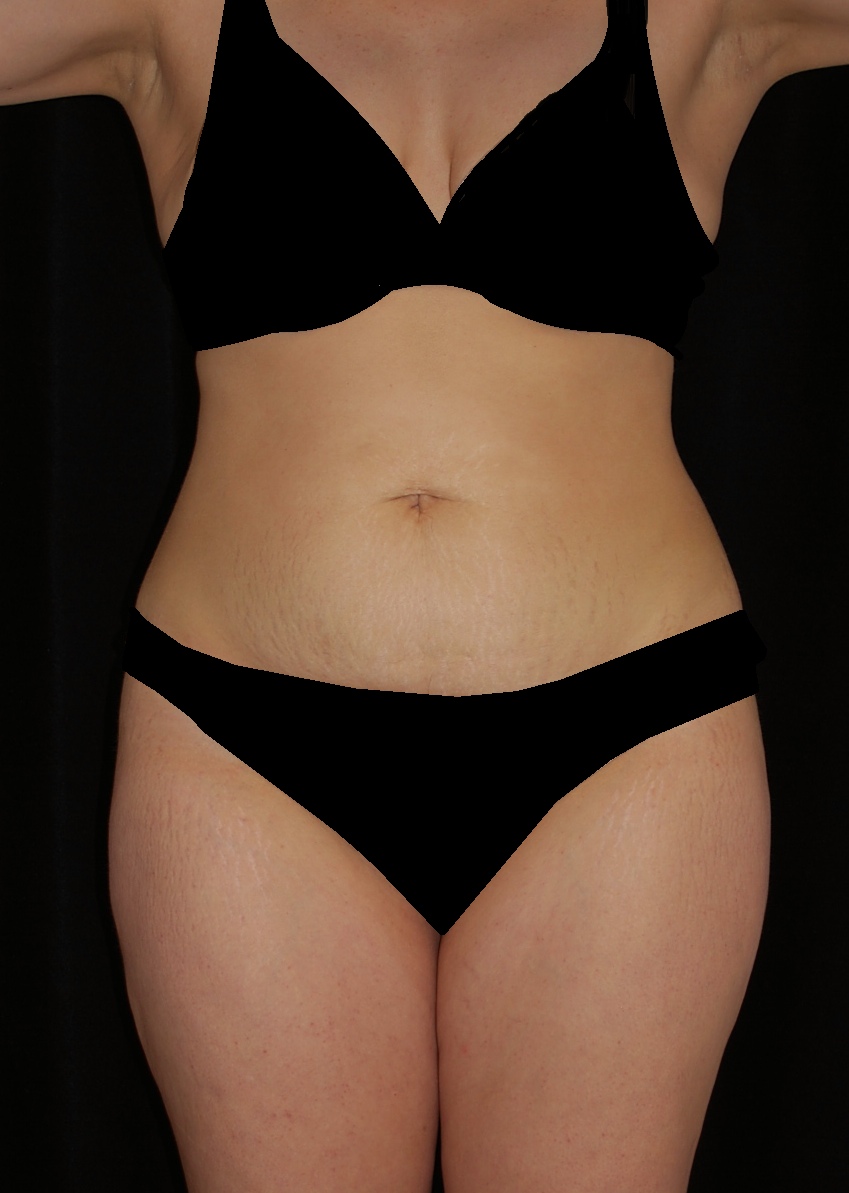 Tummy Tuck Before & After Patient #15093