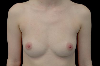 Breast Augmentation (Fat Transfer) Before & After Patient #14002