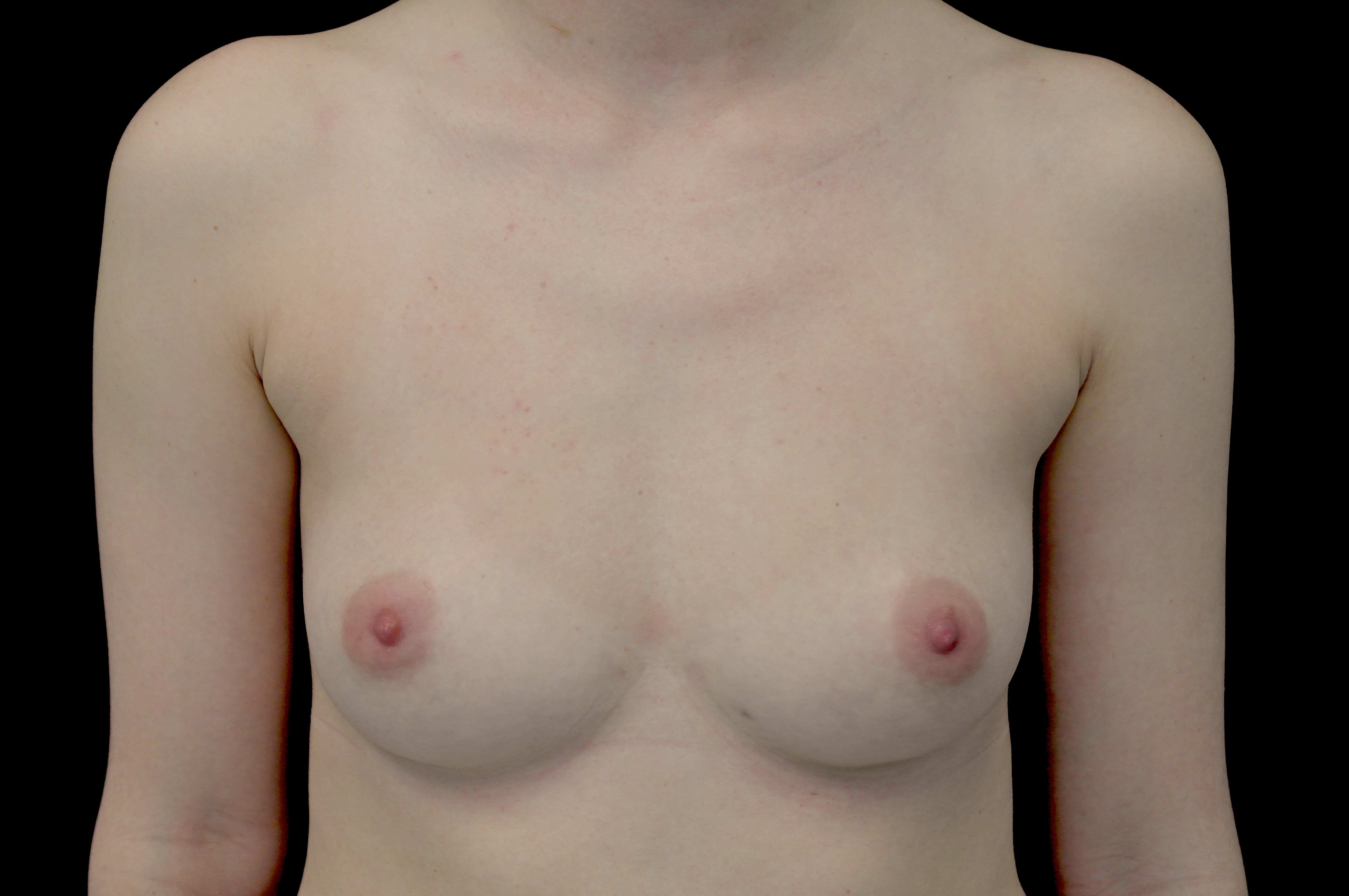Breast Augmentation (Fat Transfer) Before & After Patient #14002