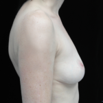 Breast Implant Removal (Explant Surgery) Before & After Patient #14692