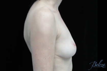 Breast Implant Removal (Explant Surgery) Before & After Patient #14692
