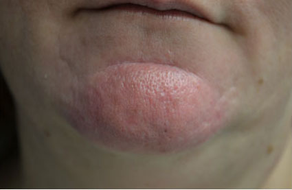 Intensive Pulse Light (IPL) Before & After Patient #14780