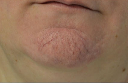 Intensive Pulse Light (IPL) Before & After Patient #14780