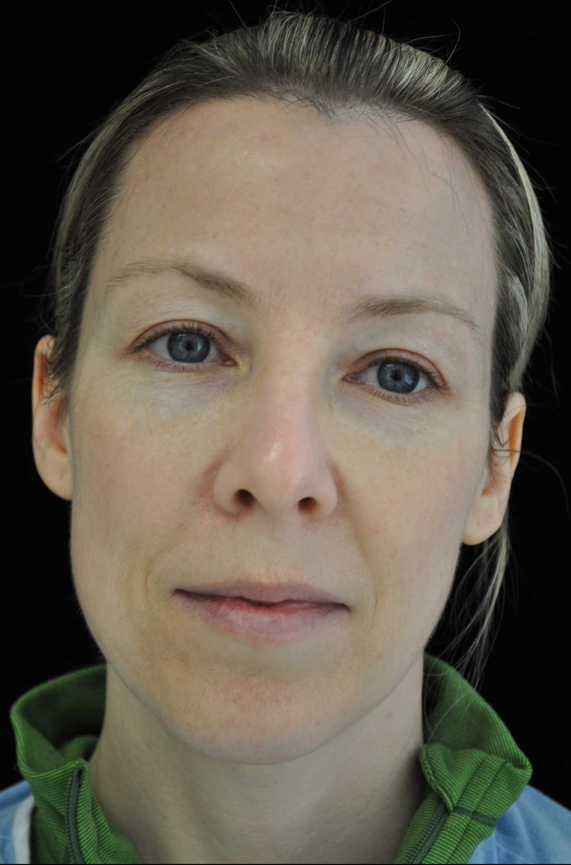 Intensive Pulse Light (IPL) Before & After Patient #14783