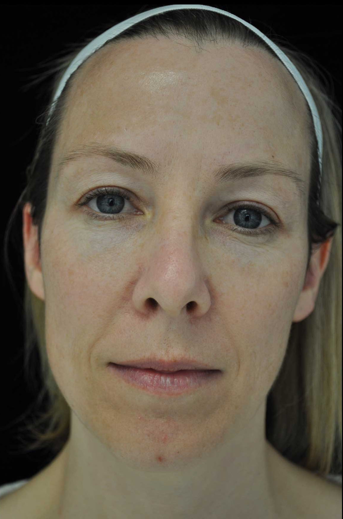 Intensive Pulse Light (IPL) Before & After Patient #14783