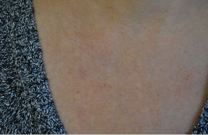 Intensive Pulse Light (IPL) Before & After Patient #14812