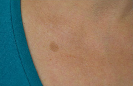 Intensive Pulse Light (IPL) Before & After Patient #14812