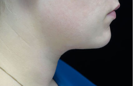 Kybella Before & After Patient #14762