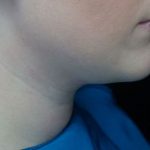 Kybella Before & After Patient #14762