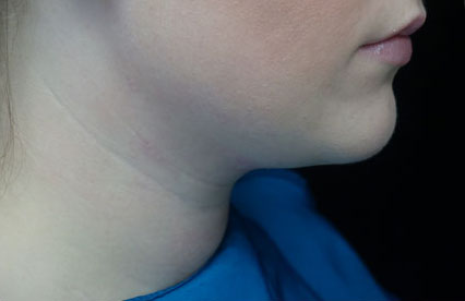 Kybella Before & After Patient #14762
