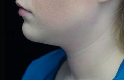 Kybella Before & After Patient #14762