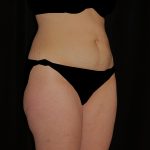 Tummy Tuck Before & After Patient #15093