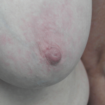 Nipple Inversion Before & After Patient #15252