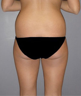 Liposuction Before & After Patient #16161