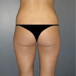 Liposuction Before & After Patient #16161