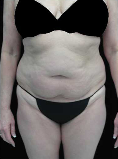 Lipoabdominoplasty Before & After Patient #15111