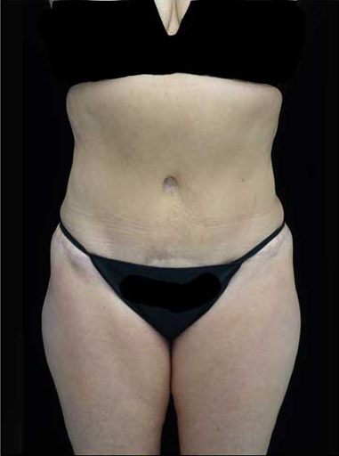 Lipoabdominoplasty Before & After Patient #15111