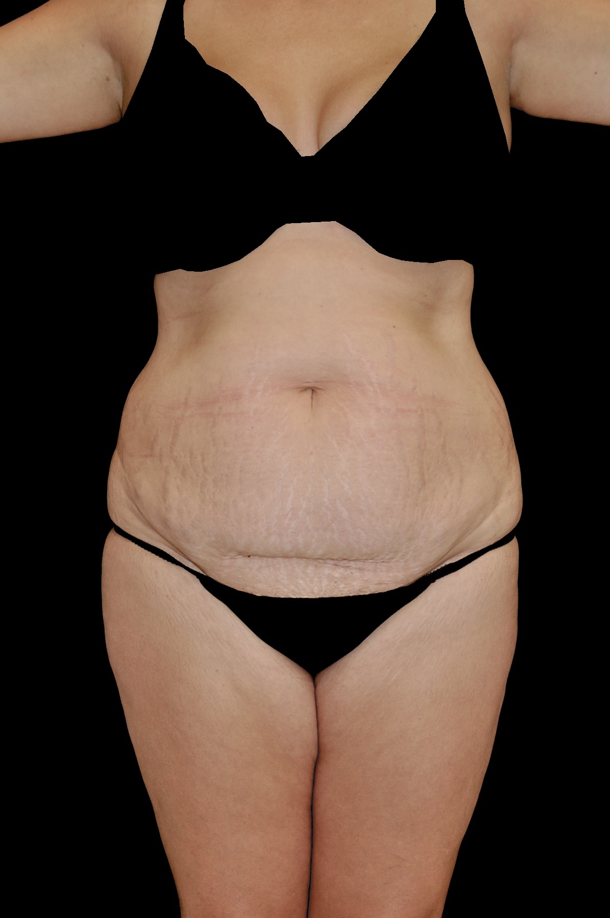 Lipoabdominoplasty Before & After Patient #15061