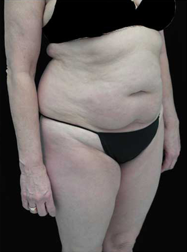Lipoabdominoplasty Before & After Patient #15111