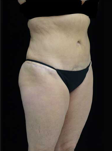 Lipoabdominoplasty Before & After Patient #15111