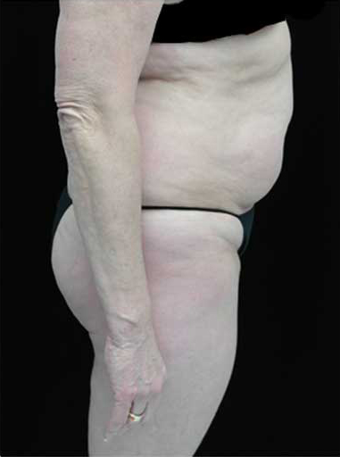Lipoabdominoplasty Before & After Patient #15111