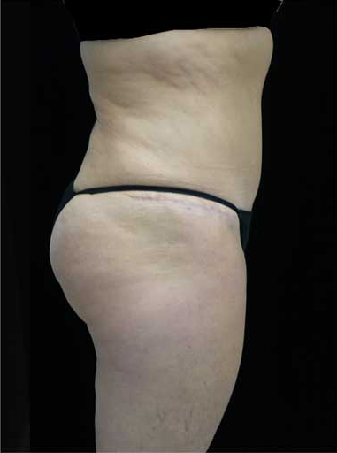 Lipoabdominoplasty Before & After Patient #15111