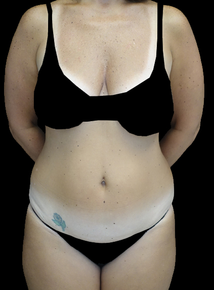 Lipoabdominoplasty Before & After Patient #15092