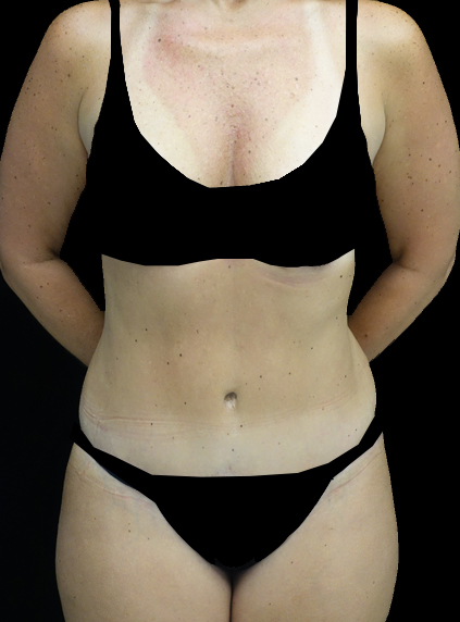 Lipoabdominoplasty Before & After Patient #15092