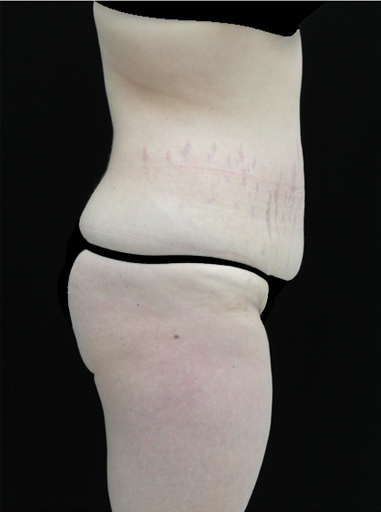 Lipoabdominoplasty Before & After Patient #15132